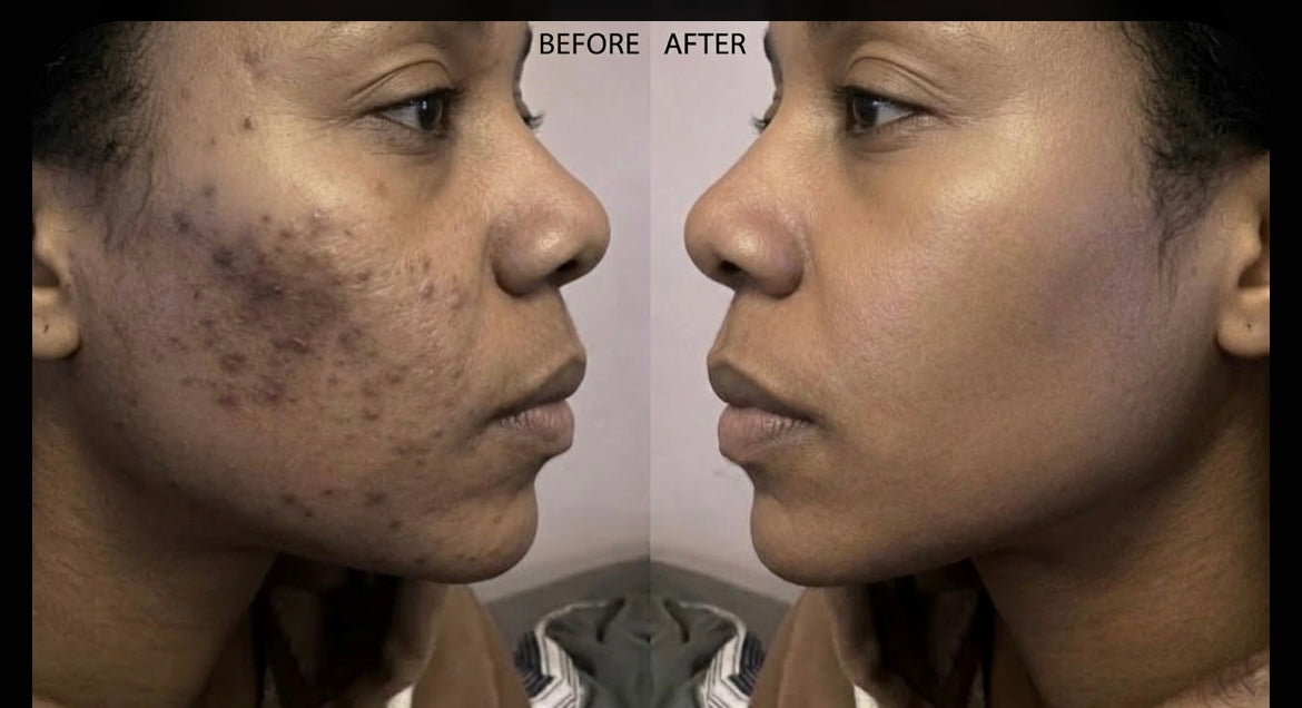 What to Expect When Treating Dark Spots: A Realistic Timeline for Results